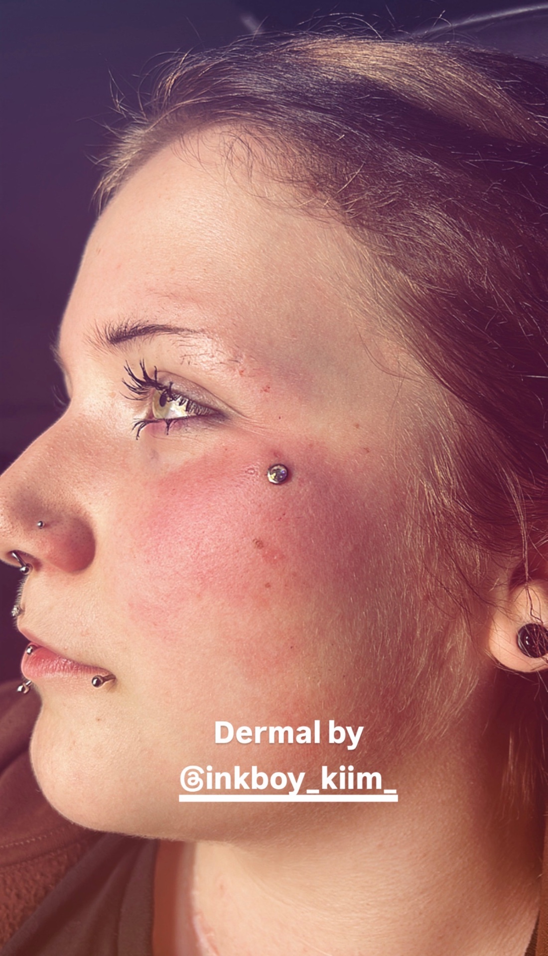 Dermal · kinn